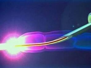 Laser lanean